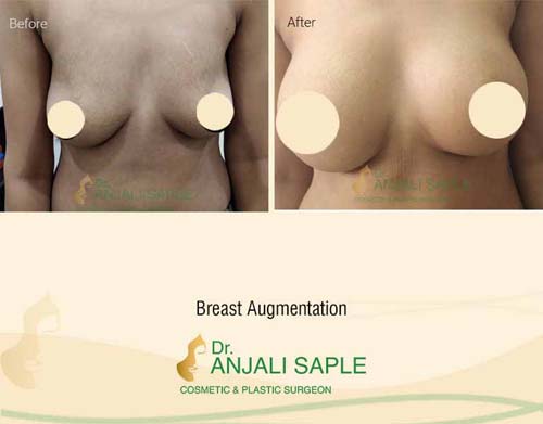 Breast augmentation before and after front view by Dr. Anjali Saple 2