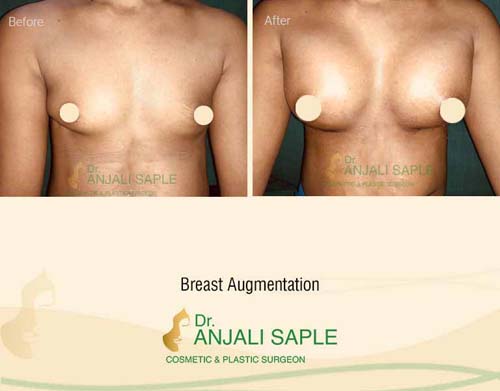 Breast augmentation before and after front view by Dr. Anjali Saple 3