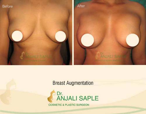 Breast augmentation before and after front view by Dr. Anjali Saple 4