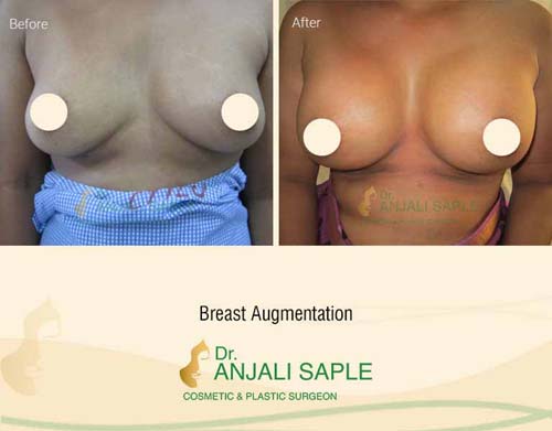 Breast augmentation before and after front view by Dr. Anjali Saple 7