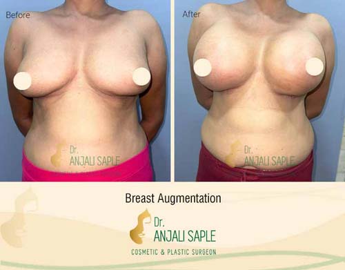 Breast augmentation before and after front view by Dr. Anjali Saple 9