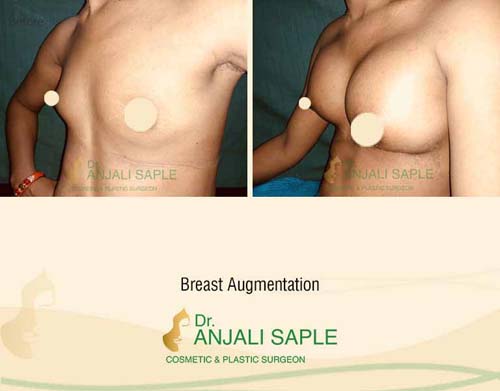 Breast augmentation before and after left side view by Dr. Anjali Saple