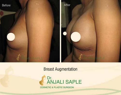Breast augmentation before and after left side view by Dr. Anjali Saple 5