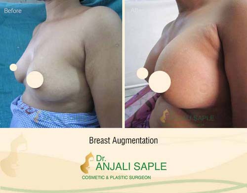 Breast augmentation before and after left side view by Dr. Anjali Saple 7