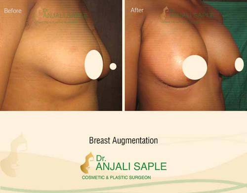 Breast augmentation before and after right side view by Dr. Anjali Saple