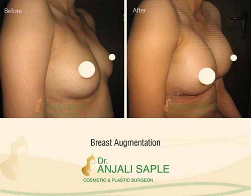 Breast augmentation before and after right side view by Dr. Anjali Saple 5