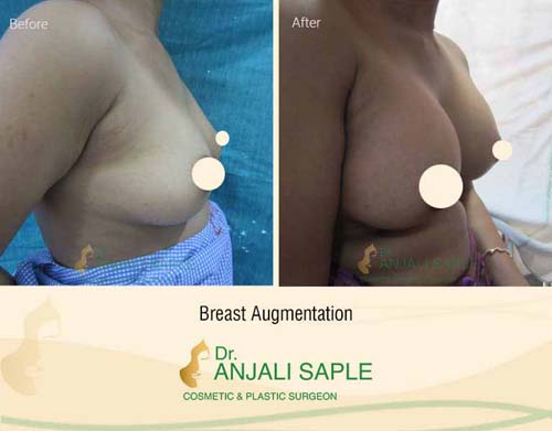 Breast augmentation before and after right side view by Dr. Anjali Saple 7