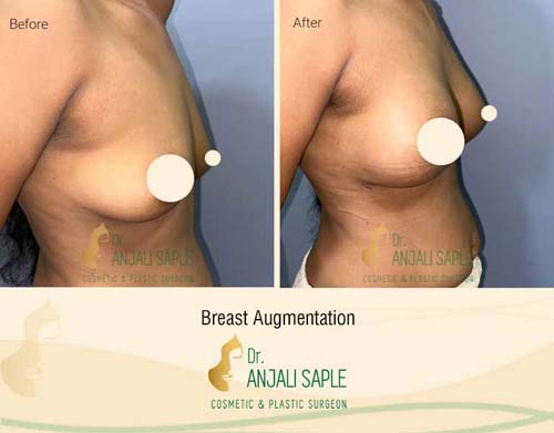 Breast augmentation before and after side view by Dr. Anjali Saple 8
