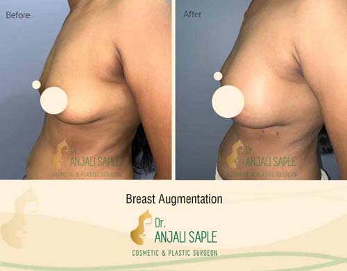 Breast augmentation before and after side view by Dr. Anjali Saple 8