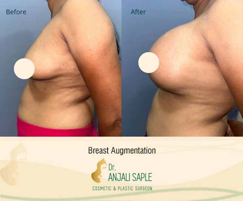 Breast augmentation before and after side view by Dr. Anjali Saple 9