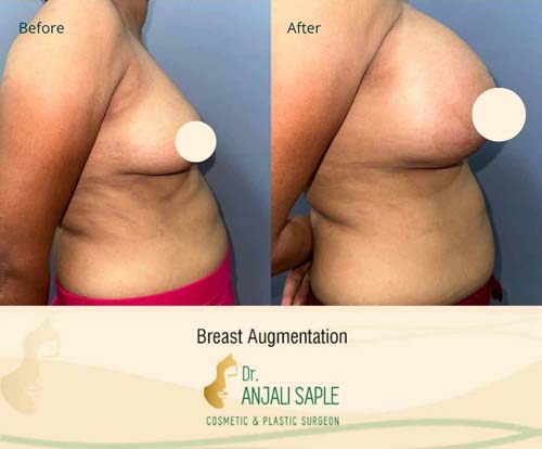 Breast augmentation before and after side view by Dr. Anjali Saple