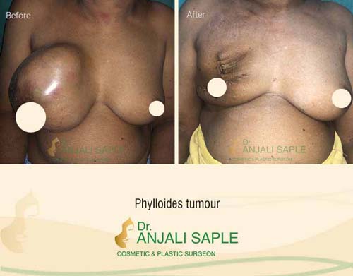 Breast reconstruction after Phylloides tumour surgery by Dr. Anjali Saple