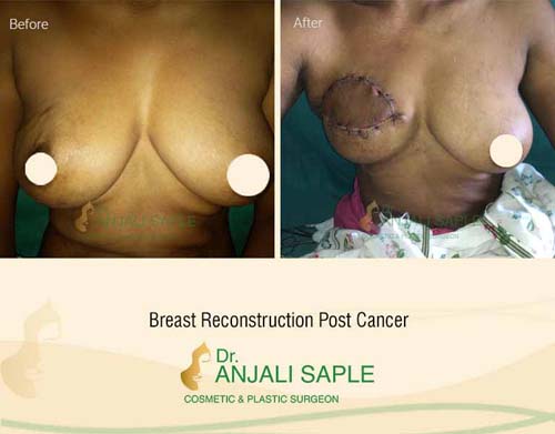 Breast reconstruction front view by Dr. Anjali Saple
