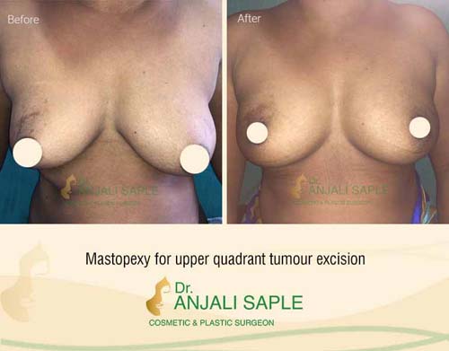Breast reconstruction mastopexy for upper quadrant tumour by Dr. Anjali Saple
