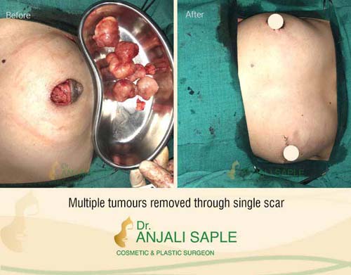 Breast reconstruction after multiple tumour removal surgery by Dr. Anjali Saple