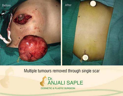 Breast reconstruction after multiple tumour removal by Dr. Anjali Saple