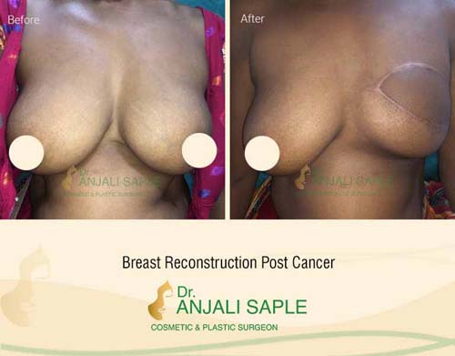 Breast reconstruction post cancer surgery by Dr. Anjali Saple 5