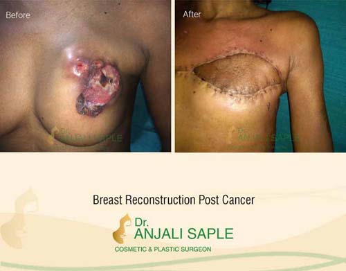 Breast reconstruction post cancer surgery by Dr. Anjali Saple 6