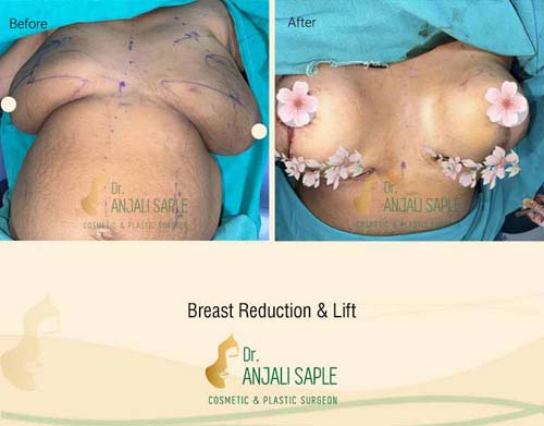 Maya’s Breast Reduction And Lift Journey