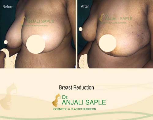 Breast reduction after case side view by Dr. Anjali Saple