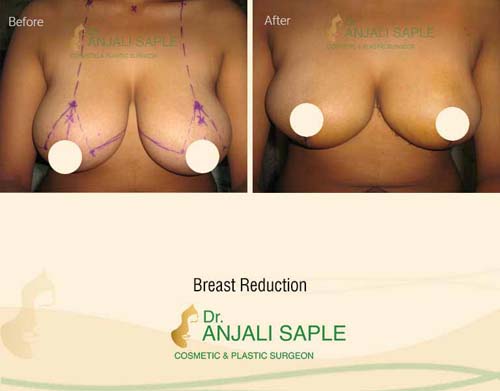 Breast reduction case front view by Dr. Anjali Saple 10