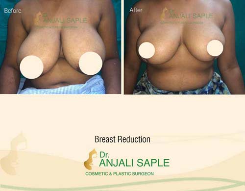 Breast reduction case front view by Dr. Anjali Saple 11