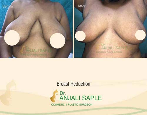 Breast reduction case front view by Dr. Anjali Saple 12