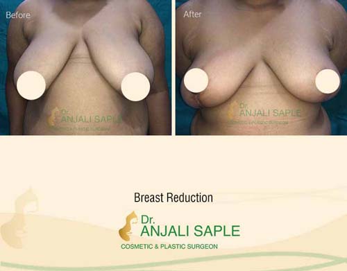 Breast reduction case front view by Dr. Anjali Saple 13