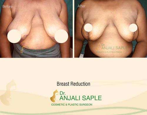 Breast reduction case front view by Dr. Anjali Saple 14