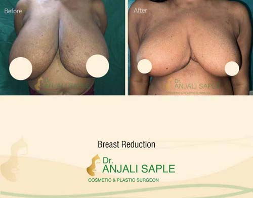 Breast reduction case front view by Dr. Anjali Saple 15