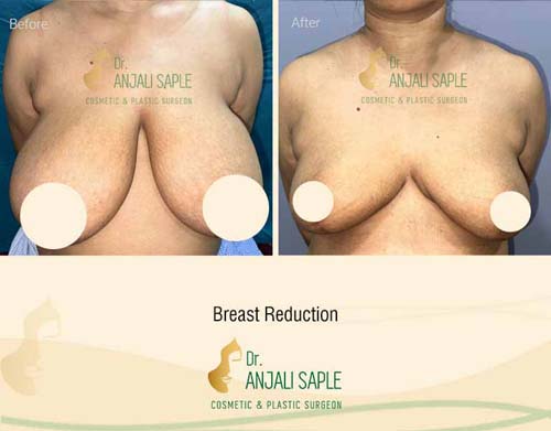 Breast reduction case front view by Dr. Anjali Saple 16