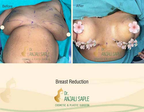 Breast reduction case front view by Dr. Anjali Saple 18