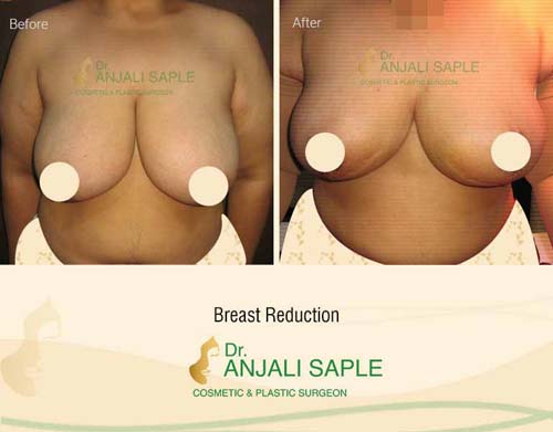 Breast reduction case front view by Dr. Anjali Saple 2