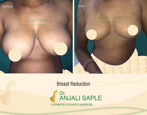 Breast reduction case front view by Dr. Anjali Saple 3