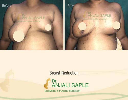 Breast reduction case front view by Dr. Anjali Saple 4