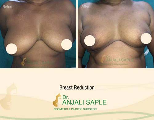 Breast reduction case front view by Dr. Anjali Saple 6