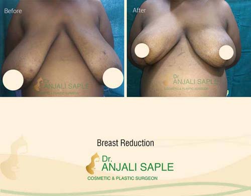 Breast reduction case front view by Dr. Anjali Saple 7
