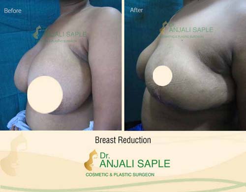 Breast reduction left side view case by Dr. Anjali Saple 5