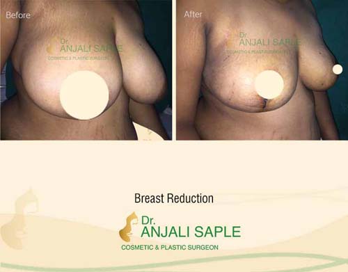 Breast reduction case right view by Dr. Anjali Saple 1