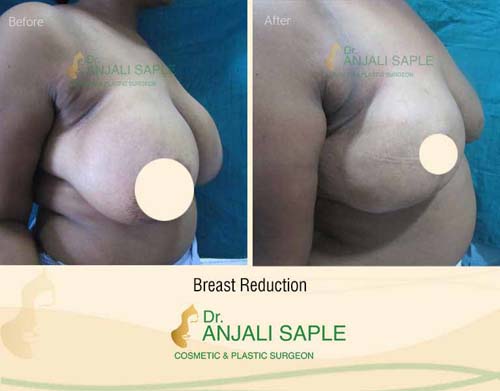Breast reduction case right view by Dr. Anjali Saple 5