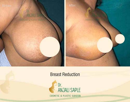 Right side view of before and after image for breast reduction surgery