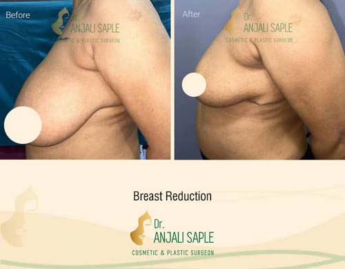 Breast reduction case side view by Dr. Anjali Saple 16