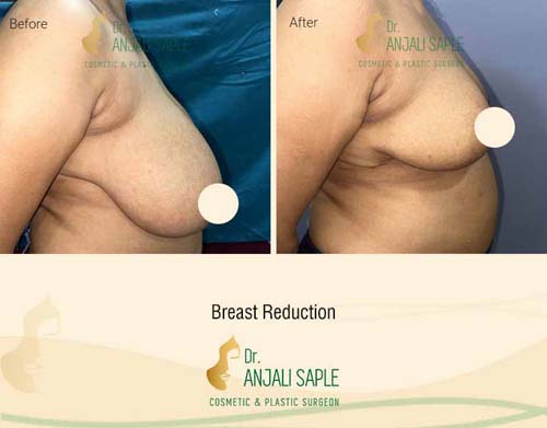 Breast reduction case side view by Dr. Anjali Saple 16