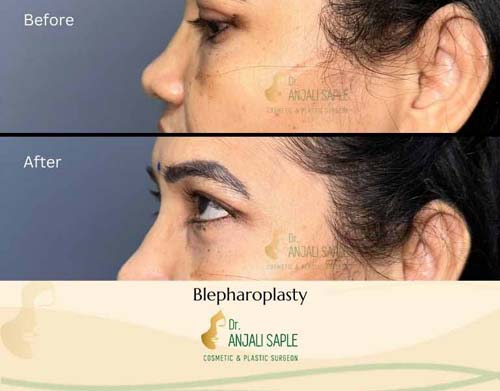 Eyelid surgery left view case 3