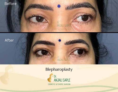Eyelid surgery case 3