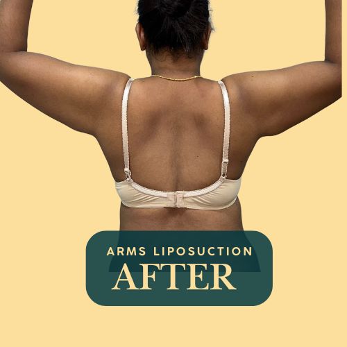 Arms Liposuction - After