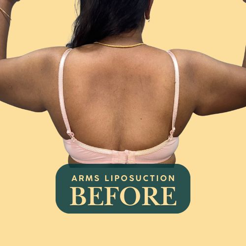 Arms Liposuction - Before