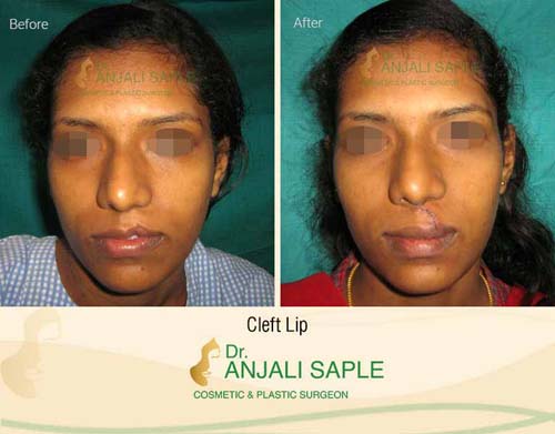 Cleft lip case bottom view by Dr. Anjali Saple 1