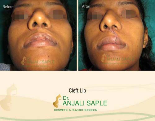 Cleft lip case bottom view by Dr. Anjali Saple