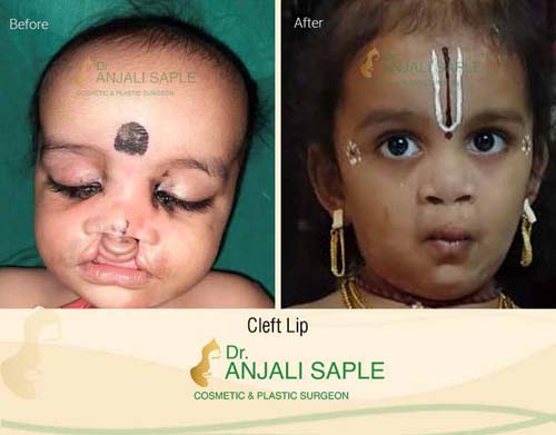 Case 1: Cleft Lip and Palate Surgery